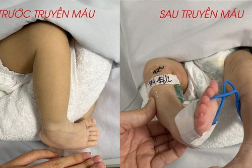 Sự hồi sinh kỳ diệu của bé sơ sinh có nhóm máu hiếm