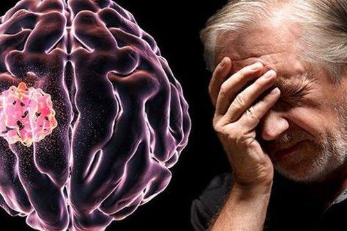 Liệu pháp mới có thể chống lại khối u não