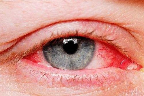 Điều trị viêm kết mạc