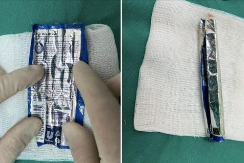 Gắp chiếc vỏ kem xả tóc dài 6cm từ niệu đạo người đàn ông