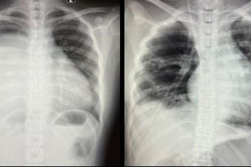 Phát hiện xương, tóc trong khối u ở ngực