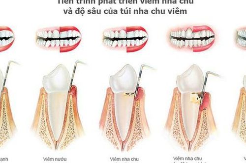 Các phương pháp điều trị viêm nha chu