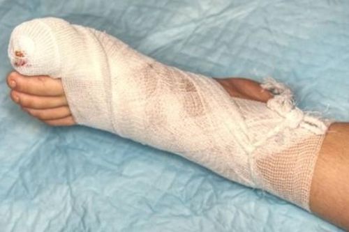 Lạm dụng kháng sinh, người đàn ông suýt cụt chi
