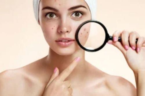 6 cách trị mụn bằng nguyên liệu tự nhiên tại nhà nhanh - hiệu quả chỉ sau 1 - 2 lần áp dụng