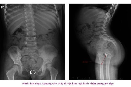Chiếc nhẫn 'đi lạc' trong vùng kín của bé gái 4 tuổi