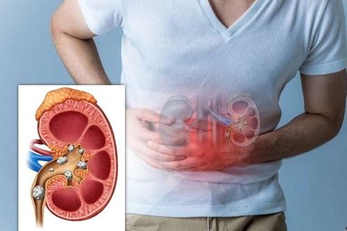 Lưu ý khi xây dựng chế độ ăn uống cho người bị sỏi thận
