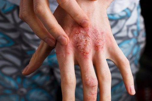 Thuốc trị bệnh viêm da dị ứng nặng