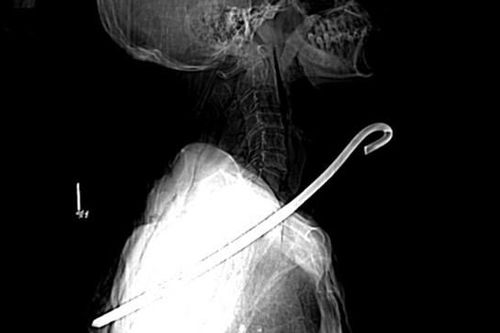 Cứu sống cụ ông bị khúc sắt dài khoảng 30cm đâm thấu cổ