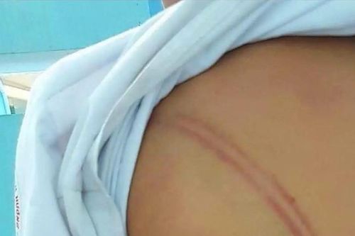 Cà Mau: Khởi tố mẹ kế đánh con chồng để lại 20 vết bầm tím
