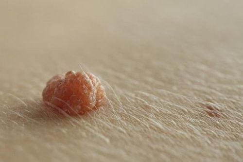 5 loại mụn tuyệt đối không được nặn