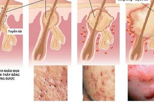 Những điều cần biết về điều trị mụn trứng cá