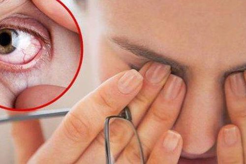 Cách đối phó với các đợt tăng nặng của khô mắt