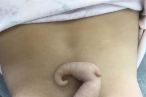 Bé gái chào đời với chiếc đuôi dài 6cm