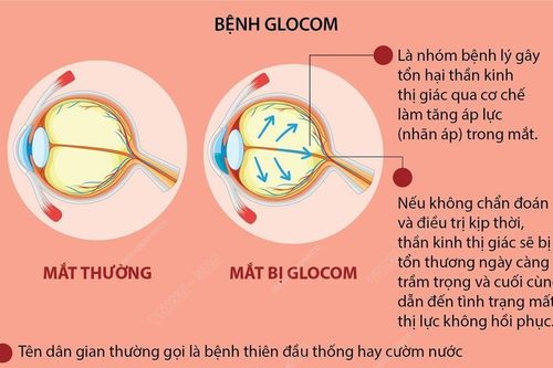 Tuần lễ Glocom Thế giới: Tầm soát và phát hiện bệnh sớm