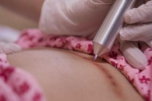 Mẹ bầu có nên chiếu tia plasma sau sinh để mau chóng hồi phục không?