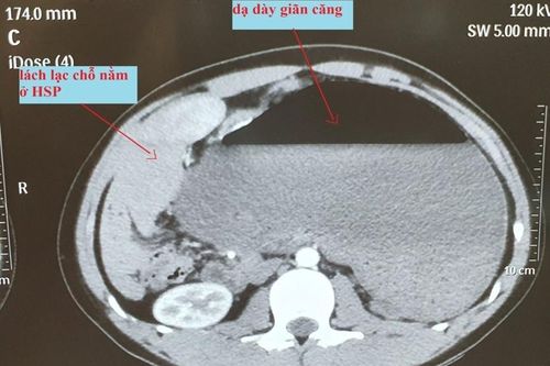 Hiếm gặp: Dạ dày của nam thanh niên tự xoắn 180 độ, lách và thận nằm lạc chỗ