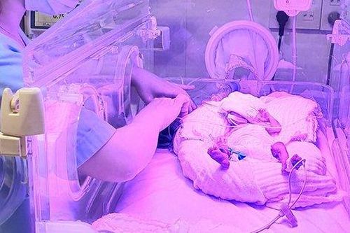 3 tháng diệu kỳ với bé gái sinh non ở tuần 24, nặng vỏn vẹn 700g