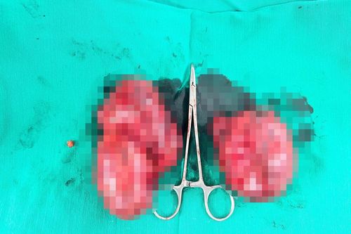 Ca đại phẫu sinh tử cắt khối u tuyến giáp 'khổng lồ' cứu người phụ nữ dân tộc Nùng