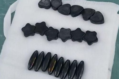 Bé trai nuốt 20 viên nam châm phải cắt bỏ 1 đoạn ruột