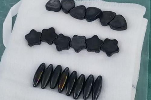 Nuốt 20 viên nam châm, bé trai phải cắt 15cm ruột