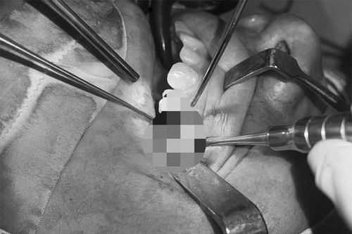 Lý do khiến nam thanh niên liên tục chảy máu mũi sau khi nhổ răng