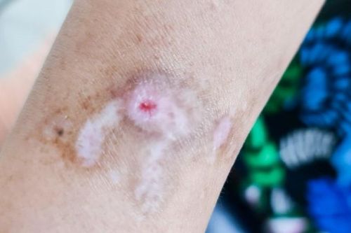 Người phụ nữ suốt một năm tự cào rách da để giải tỏa căng thẳng