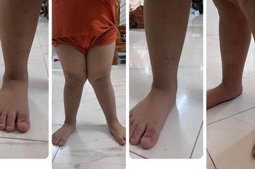 Bàn chân bẹt: Chuyên gia tiết lộ thời điểm vàng mẹ cần cho con đi khám