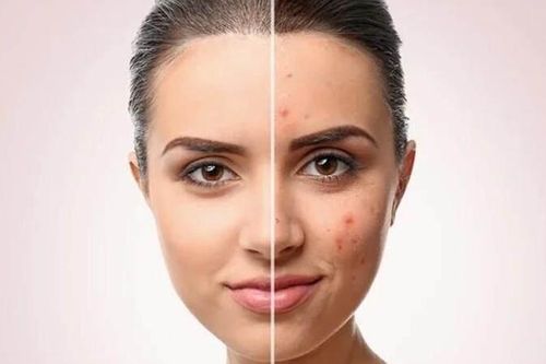 7 loại thực phẩm tự nhiên có công dụng trị mụn trứng cá hiệu quả