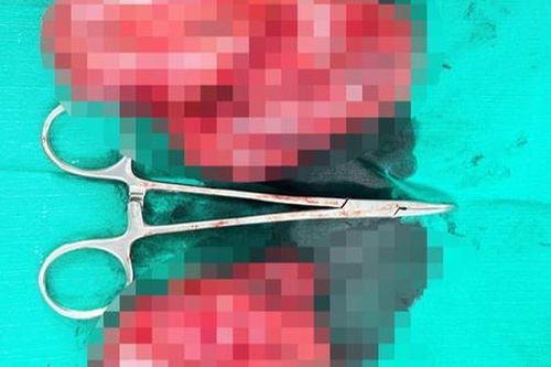 Ca đại phẫu sinh tử suốt 3 giờ đồng hồ căng thẳng cắt khối u tuyến giáp 'khủng' cứu người bệnh