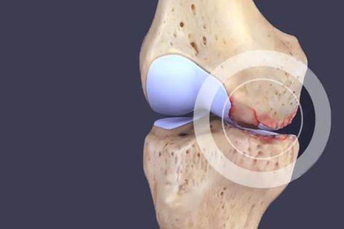 Thoái hóa khớp là gì, có chữa được không?