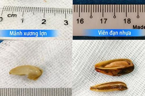 Nhiều trẻ rơi vào tình trạng nguy kịch, nghẽn đường thở do hóc dị vật