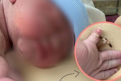 Hi hữu bé gái chào đời cùng vòng tránh thai: Tại sao đặt vòng vẫn có thai?
