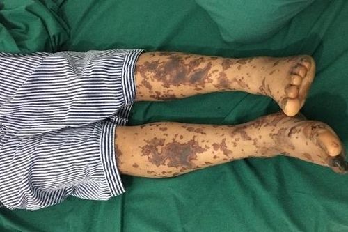 Thông tin tuyên truyền phòng, chống bệnh liên cầu lợn trên người