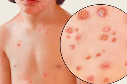 5 món ăn thuốc bổ dưỡng, chăm sóc trẻ bị thủy đậu