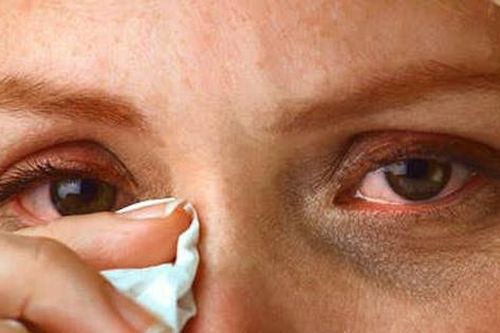Các thuốc điều trị dị ứng mắt