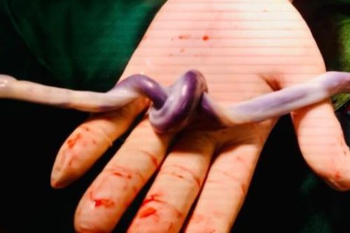 Bé gái chào đời cùng dây rốn thắt nút hiếm gặp