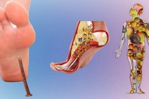 Không lơ là với nhiễm trùng uốn ván