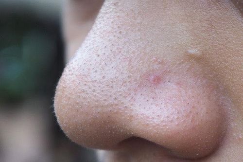 Những phương pháp tránh tắc lỗ chân lông vùng mũi