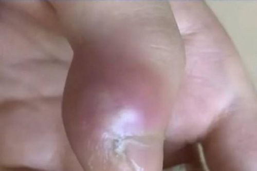 Nghiện cắn móng tay, bé trai suýt cụt luôn ngón
