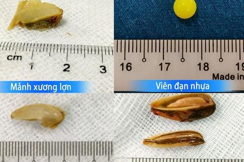 Bác sĩ hướng dẫn sơ cứu hóc dị vật