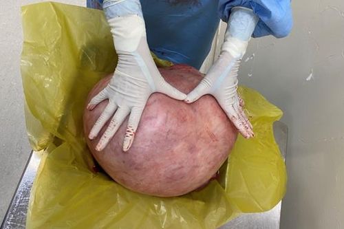 Khối u hơn 11kg chèn ép khoang bụng người phụ nữ