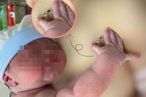 Hy hữu: Bé gái chào đời cùng vòng tránh thai của mẹ, chuyên gia lý giải đặt vòng tránh thai vẫn có thể mang thai