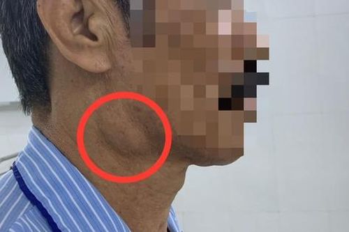 Sưng góc hàm 8 năm, đi khám người đàn ông bất ngờ bị u tuyến nước bọt