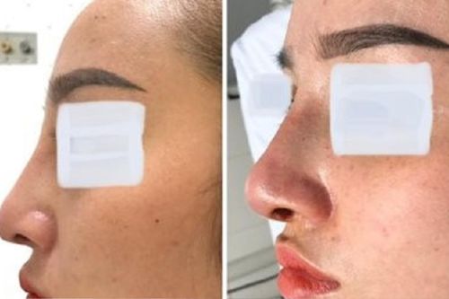 Cô gái 26 tuổi bị áp xe sau khi phẫu thuật nâng mũi
