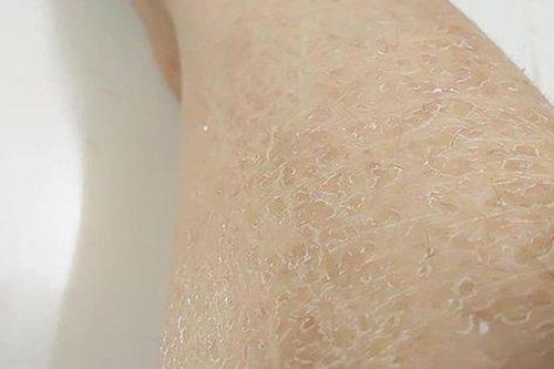 Bệnh da vảy cá là gì ? Nguyên nhân và phương pháp điều trị