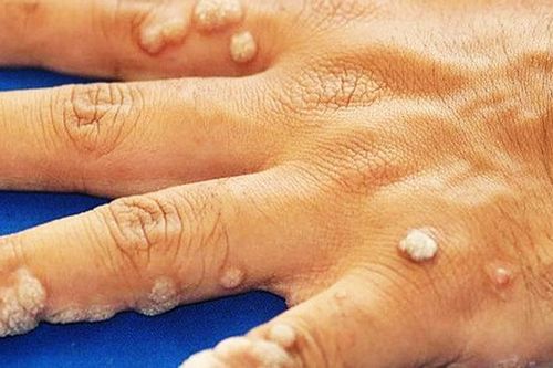 3 công thức trị mụn cóc không tốn tiền