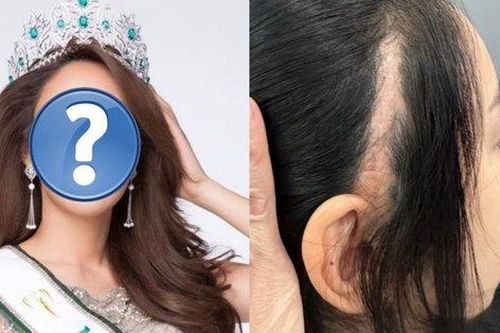 Hoa hậu Thái Lan đăng ảnh sẹo dài ở đầu sau phẫu thuật thẩm mỹ