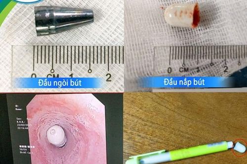Nuốt phải đầu bút bi, bé 7 tuổi nhập viện trong tình trạng nguy kịch