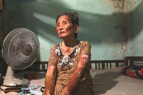 Người bị phỏng, người đau bệnh cần giúp đỡ