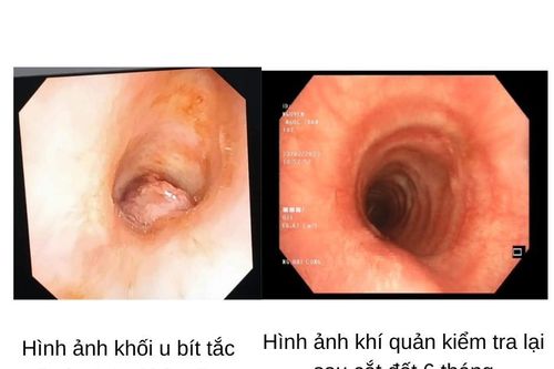 Coi chừng bít tắc khí quản do polyp